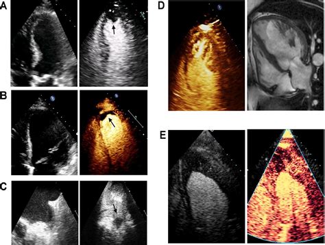 echocardiogram with contrast protocol